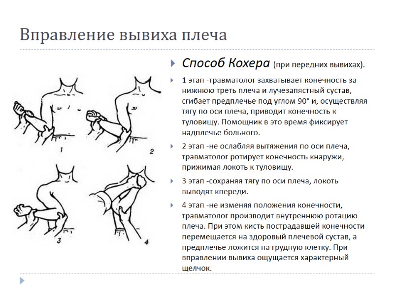 Вправление вывиха плеча Способ Кохера (при передних вывихах).  1 этап -травматолог захватывает конечность